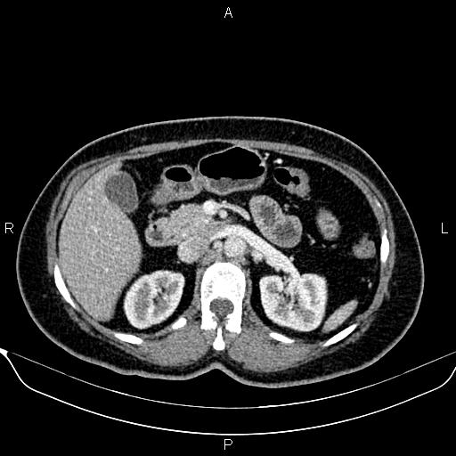 Bilateral benign adrenal adenomas (Radiopaedia 86912-103124 B 40).jpg
