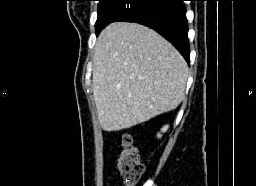 Bilateral benign adrenal adenomas (Radiopaedia 86912-103124 E 16).jpg