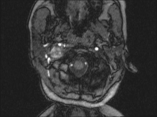 Bilateral carotid body tumors and right glomus jugulare tumor (Radiopaedia 20024-20060 Axial MRA 297).jpg
