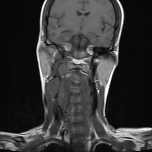 File:Bilateral carotid body tumors and right jugular paraganglioma (Radiopaedia 20024-20060 Coronal 10).jpg