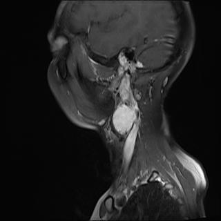 File:Bilateral carotid body tumors and right jugular paraganglioma (Radiopaedia 20024-20060 Sagittal 5).jpg