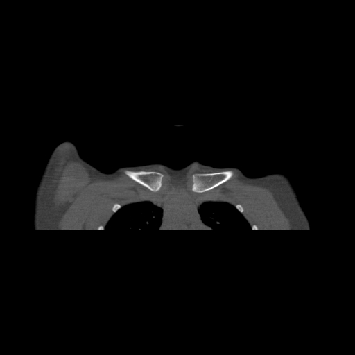 File:Bilateral chronic posterior shoulder dislocation (Radiopaedia 39213-41452 Coronal bone window 6).jpg