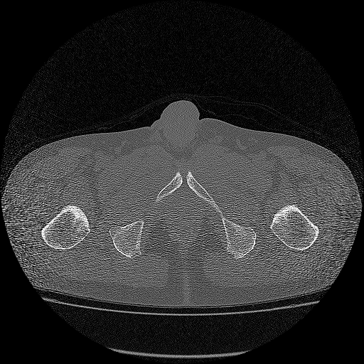 Bilateral femoral neck stress fractures (Radiopaedia 28666-28954 Axial bone window 75).png