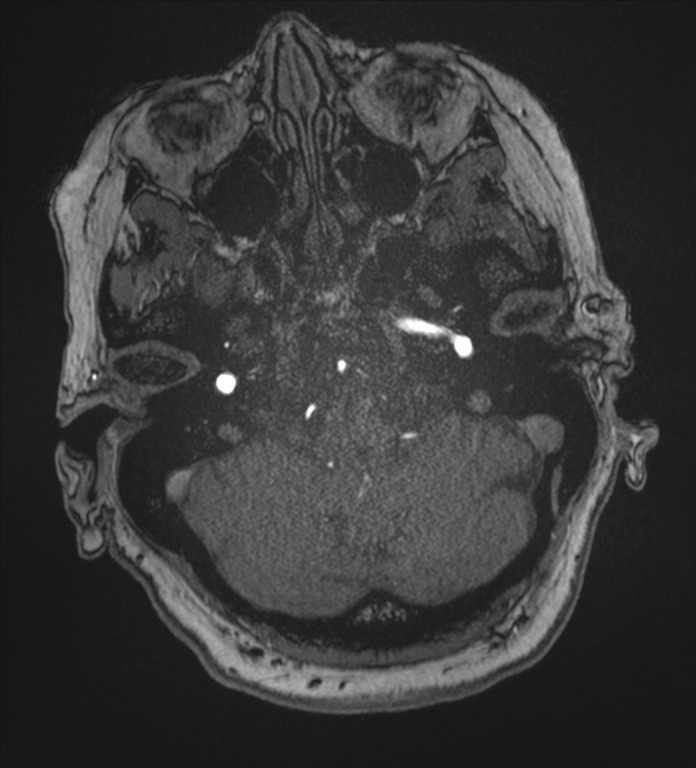 Bilateral fetal posterior communicating arteries (Radiopaedia 41286-44102 Axial MRA 26).png