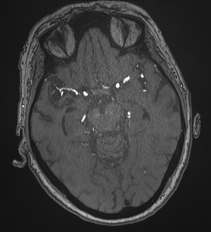 Bilateral fetal posterior communicating arteries (Radiopaedia 41286-44102 Axial MRA 84).png