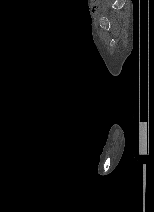 Bilateral fibular hemimelia type II (Radiopaedia 69581-79491 Sagittal bone window 57).jpg