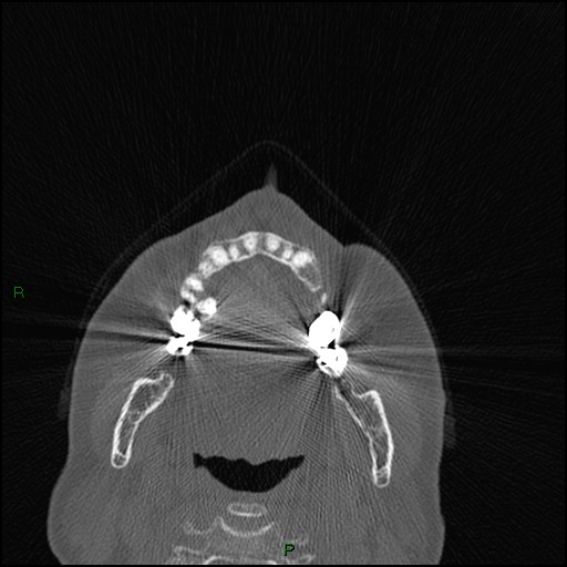 File:Bilateral frontal mucoceles (Radiopaedia 82352-96454 Axial bone window 262).jpg