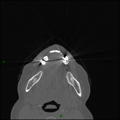 Bilateral frontal mucoceles (Radiopaedia 82352-96454 Axial bone window 299).jpg
