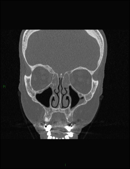 Bilateral frontal mucoceles (Radiopaedia 82352-96454 Coronal 127).jpg