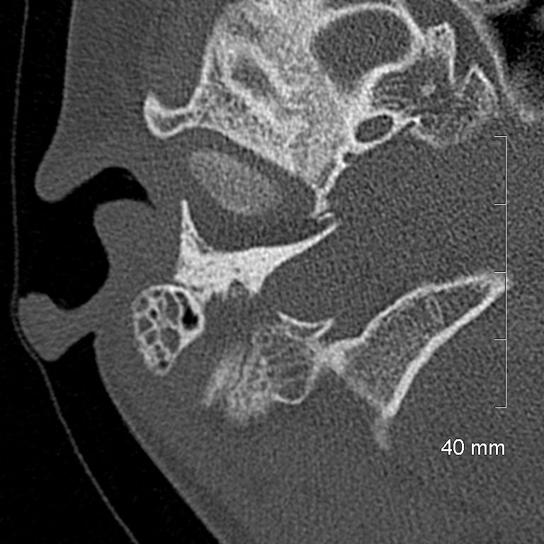 Bilateral grommets (Radiopaedia 47710-52404 Axial bone window 13).jpg