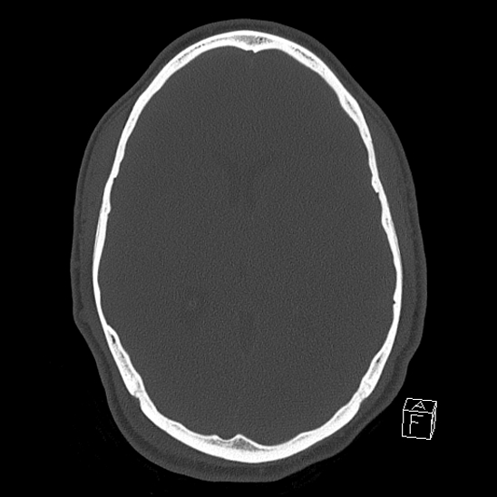 Bilateral occipital condyle fracture (type 2) (Radiopaedia 87675-104089 Axial bone window 73).jpg