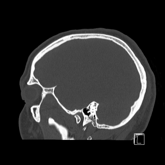 Bilateral occipital condyle fracture (type 2) (Radiopaedia 87675-104089 Sagittal bone window 16).jpg