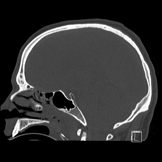 Bilateral occipital condyle fracture (type 2) (Radiopaedia 87675-104089 Sagittal bone window 51).jpg