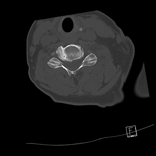 Bilateral occipital condyle fractures (type 3) (Radiopaedia 87672-104086 Axial bone window 51).jpg