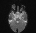 File:Bilateral optic pathway gliomas (Radiopaedia 40013-42514 Axial DWI 4).jpg