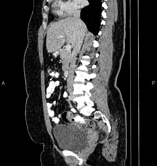 Bilateral ovarian dermoid cysts (Radiopaedia 85785-101603 D 39).jpg