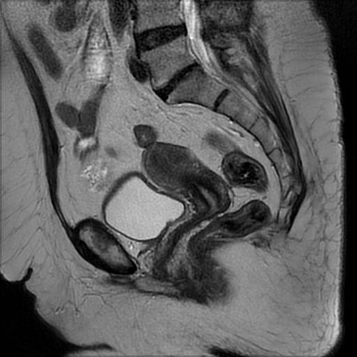 File:Bilateral ovarian dermoid cysts (Radiopaedia 90152-107338 Sagittal T2 14).jpg