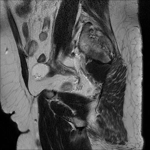 File:Bilateral ovarian dermoid cysts (Radiopaedia 90152-107338 Sagittal T2 20).jpg