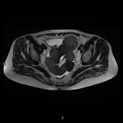File:Bilateral ovarian fibroma (Radiopaedia 44568-48293 Axial T2 15).jpg