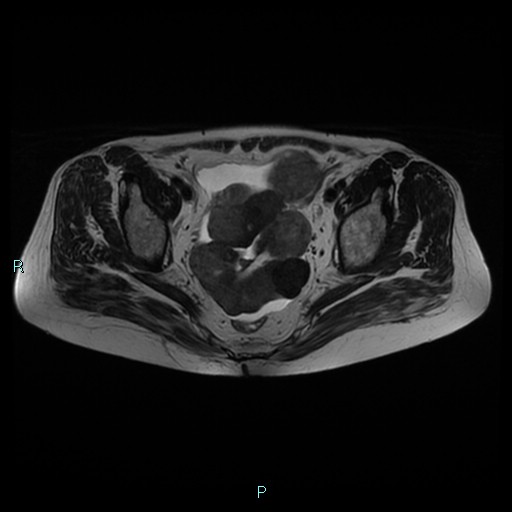 File:Bilateral ovarian fibroma (Radiopaedia 44568-48293 Axial T2 16).jpg