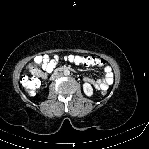 Bilateral ovarian serous cystadenocarcinoma (Radiopaedia 86062-101989 B 49).jpg