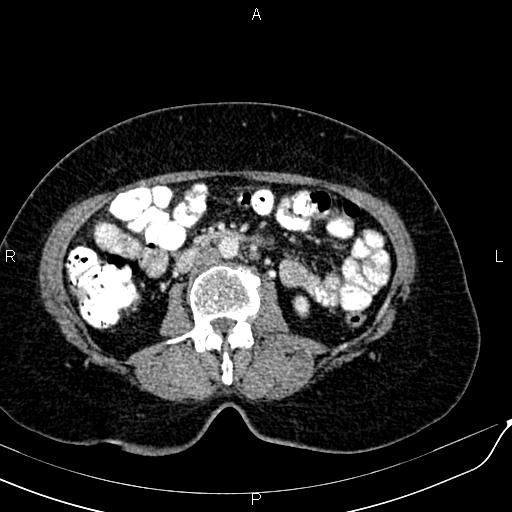 Bilateral ovarian serous cystadenocarcinoma (Radiopaedia 86062-101989 B 51).jpg