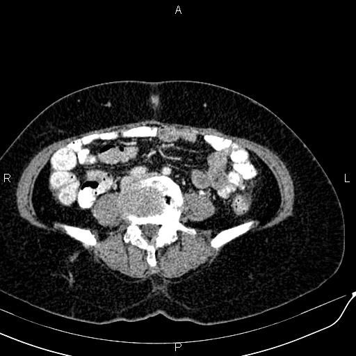 Bilateral ovarian serous cystadenocarcinoma (Radiopaedia 86062-101989 B 65).jpg