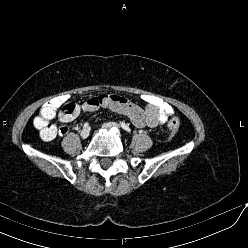 Bilateral ovarian serous cystadenocarcinoma (Radiopaedia 86062-101989 B 69).jpg