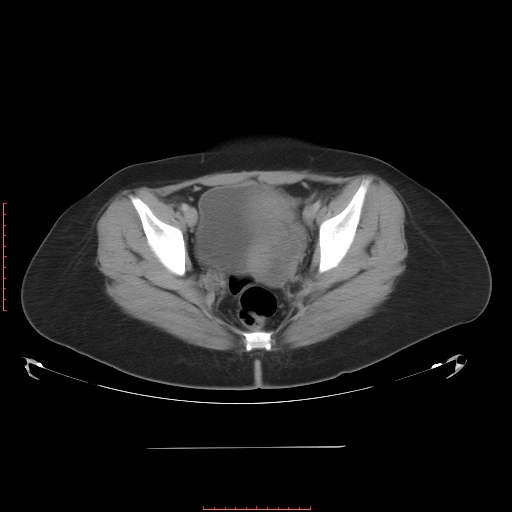 File:Bilateral ovarian serous cystadenocarcinoma with right ovarian torsion (Radiopaedia 32640-33611 A 38).jpg