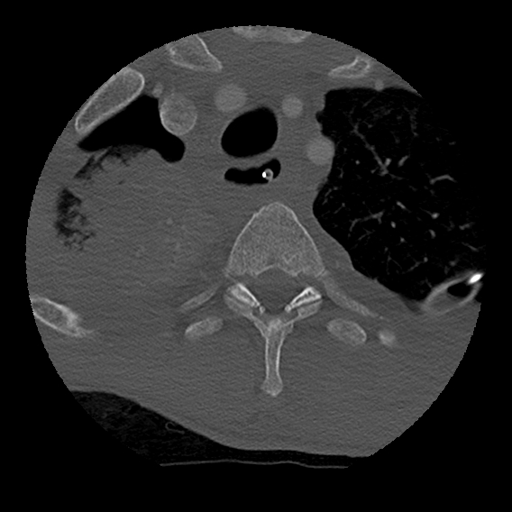 Bilateral perched facets with cord injury (Radiopaedia 45587-49713 Axial bone window 118).jpg