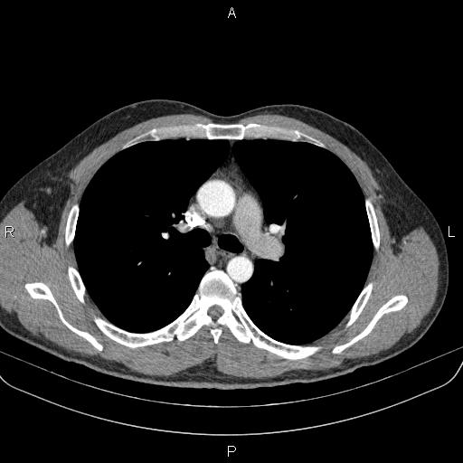 Bilateral pulmonary AVM (Radiopaedia 83134-97505 A 29).jpg