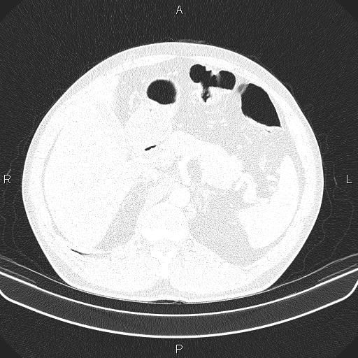 File:Bilateral pulmonary AVM (Radiopaedia 83134-97505 Axial lung window 77).jpg