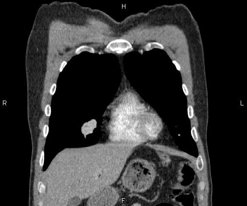 Bilateral pulmonary AVM (Radiopaedia 83134-97505 C 19).jpg