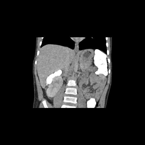 File:Bilateral renal malrotation (Radiopaedia 30901-31606 B 17).jpg