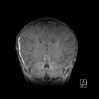 Bilateral subdural hemorrhage and parietal skull fracture (Radiopaedia 26058-26190 Coronal T1 34).png