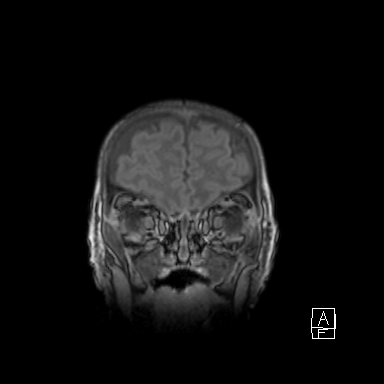 Bilateral subdural hemorrhage and parietal skull fracture (Radiopaedia 26058-26190 Coronal T1 8).png