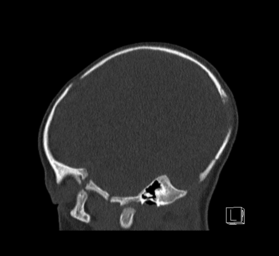 Bilateral subdural hemorrhage and parietal skull fracture (Radiopaedia 26058-26192 Sagittal bone window 20).png