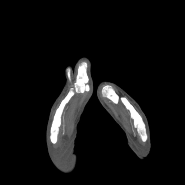 Bilateral superficial femoral arterial occlusion (Radiopaedia 25682-25857 A 96).jpg