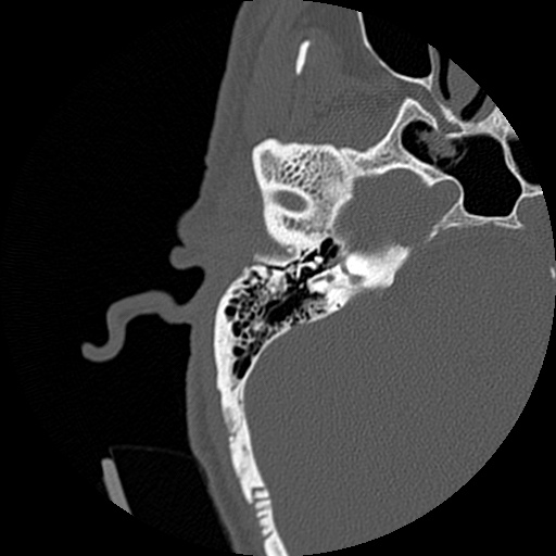 File:Bilateral temporal bone fractures (Radiopaedia 29482-29970 Axial non-contrast 32).jpg