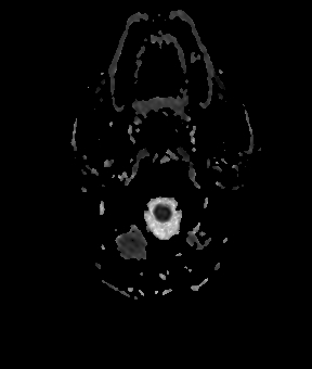 File:Bilateral thalamic gliomata (Radiopaedia 42538-45664 Axial ADC 2).jpg