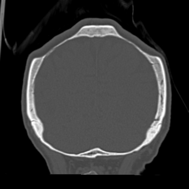 Biparietal osteodystrophy (Radiopaedia 46109-50463 Coronal bone window 86).jpg