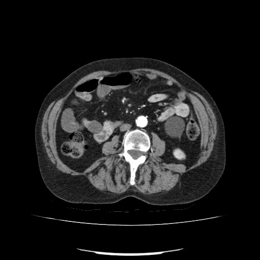 File:Bladder tumor detected on trauma CT (Radiopaedia 51809-57609 A 123).jpg