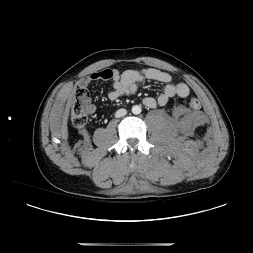 Blunt abdominal trauma with solid organ and musculoskelatal injury with active extravasation (Radiopaedia 68364-77895 A 82).jpg