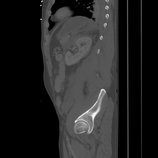 Blunt abdominal trauma with solid organ and musculoskelatal injury with active extravasation (Radiopaedia 68364-77895 Sagittal bone window 80).jpg