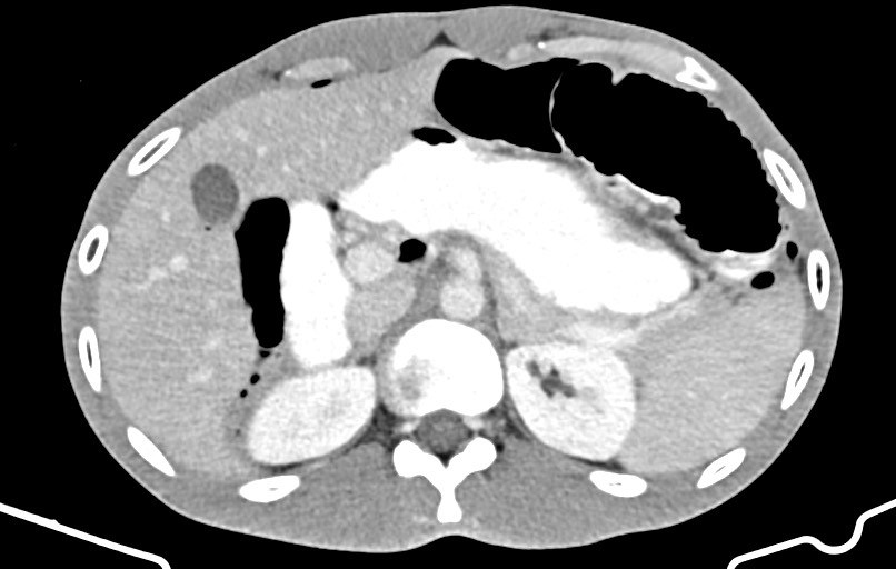 Blunt injury to the small bowel (Radiopaedia 74953-85987 A 36).jpg