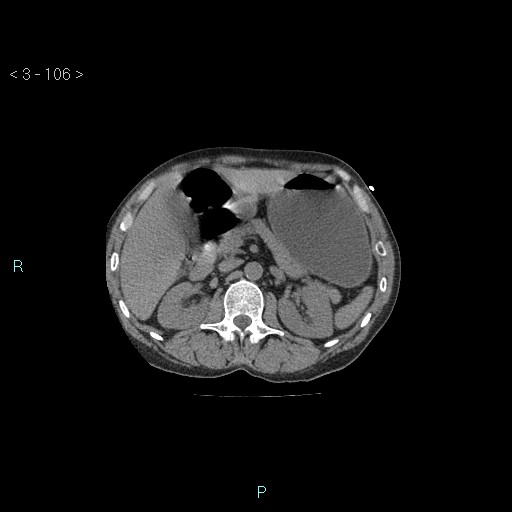 Boerhaave syndrome (Radiopaedia 27683-27897 Axial non-contrast 106).jpg