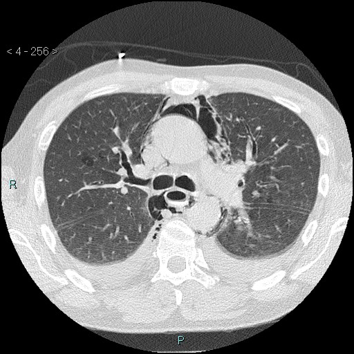 Boerhaave syndrome (Radiopaedia 27683-27897 lung window 15).jpg