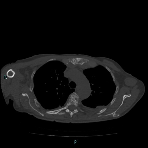 Bone metastases from untreated breast cancer (Radiopaedia 42973-46219 Axial bone window 31).jpg