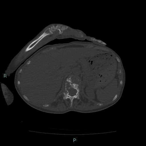 Bone metastases from untreated breast cancer (Radiopaedia 42973-46219 Axial bone window 96).jpg