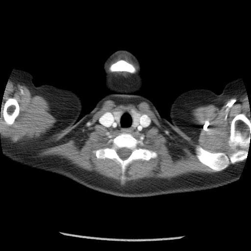 File:Borderline mucinous tumor (ovary) (Radiopaedia 78228-90808 A 1).jpg